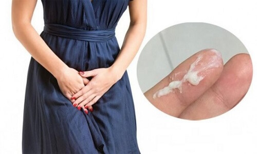 Khí hư màu trắng đục và đặc, ngứa